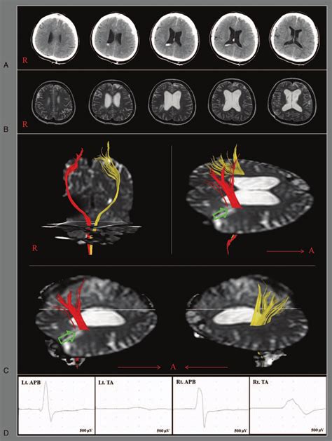 A Brain Computed Tomography Images At Onset Show Subdural And