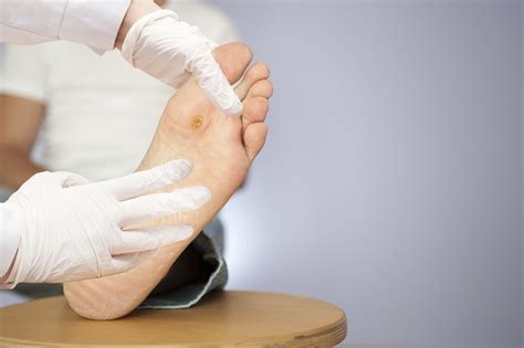 Study Suggests Possible Link Between Diabetic Foot Ulcers Diminished