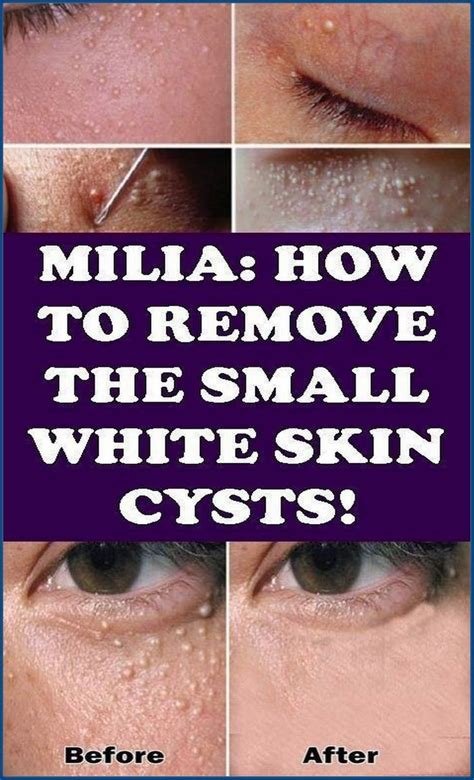 How To Remove The Small Skin Cysts Whiter Skin Cysts Skin Hot Sex