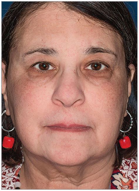 Gray Brown Patches On The Face Of A 62 Year Old Woman Dermatology