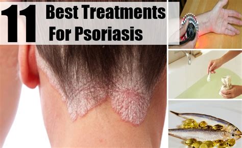 11 Best Treatments For Psoriasis Natural Home Remedies