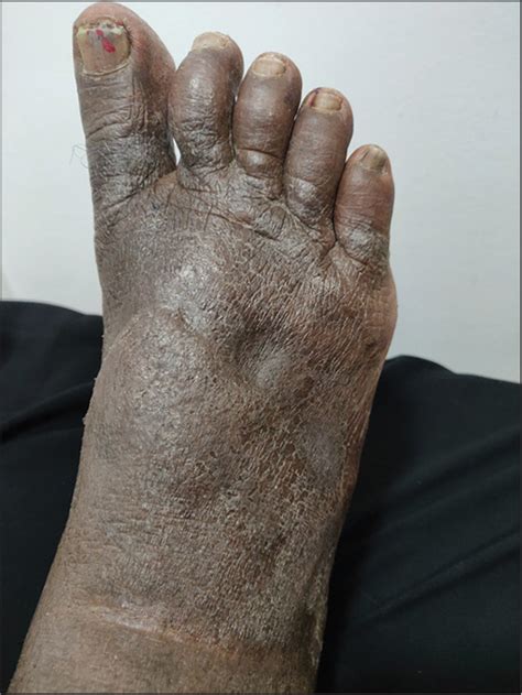 Diagnosis And Management Of Secondary Lymphedema Journal Of Skin And