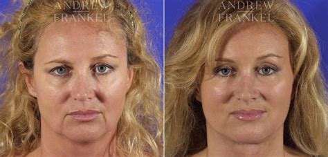 Facial Rejuvenation Photos Beverly Hills Ca Patient 11396