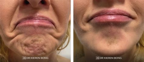 Botox Injections For Dimpled Orange Peel Chin In Glasgow Edinburgh