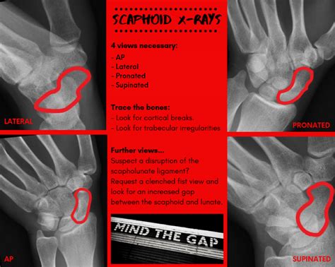 Scaphoid Xr Dont Forget The Bubbles