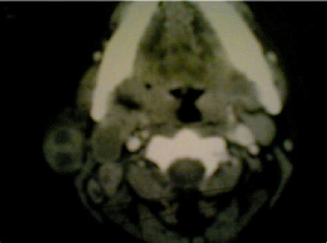 Figure 1 From An Unusual Reason Of Parotid Gland Enlargement Parotid