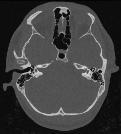 External Auditory Canal Atresia Radiology Reference Article
