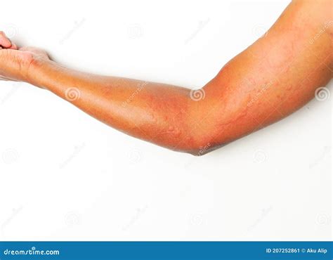 Close Up Allergy Rash On Sensitive Skin Stock Image Image Of Hand