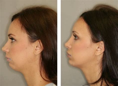 Face Toning Workouts Towards A Natural Nodal Facelift Dual Chin