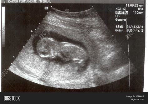 Ultrasound 14 Weeks Image And Photo Free Trial Bigstock