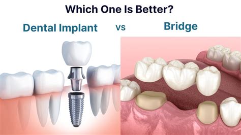 Dental Implant Vs Bridge Which One Is Better To Replace A Missing