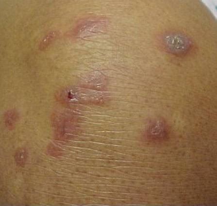 The affected skin may also feel lumpy, firmer than normal, sore, or itchy. Sarcoidosis (cutaneous sarcoidosis) - The Clinical Advisor
