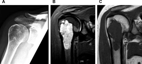 Imaging Features Of Bone Tumors Radiology Key