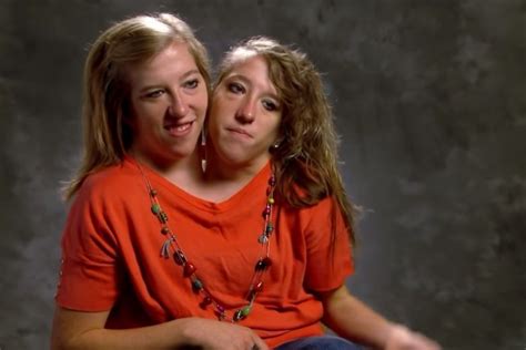 These Siamese Twins Have A Heartfelt Message That The World Needs To Hear
