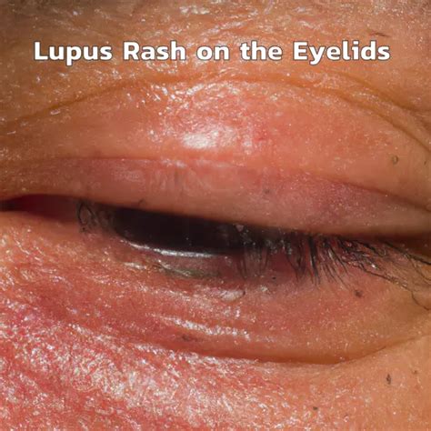 Lupus Rash On The Eyelids Symptoms Causes Treatment
