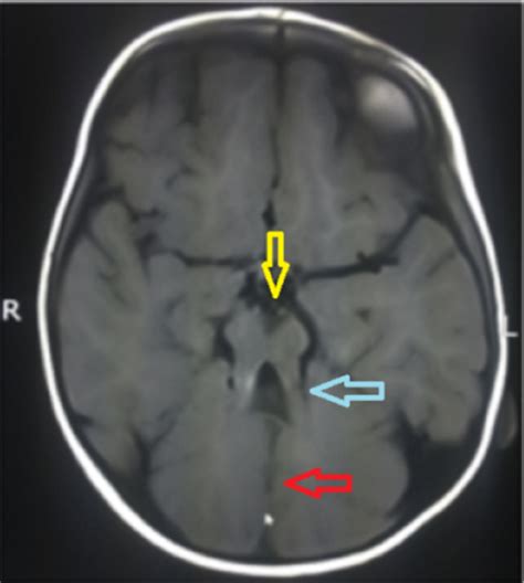 Cureus Joubert Syndrome A Rare Radiological Case
