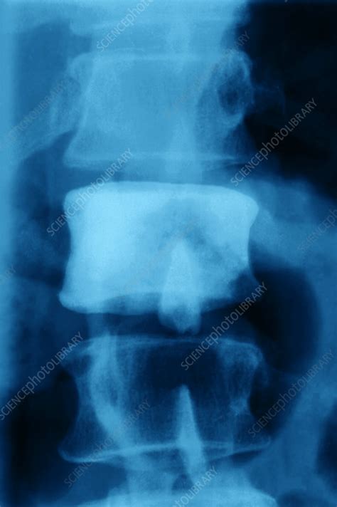 Secondary Bone Cancer X Ray Stock Image M1340682 Science Photo