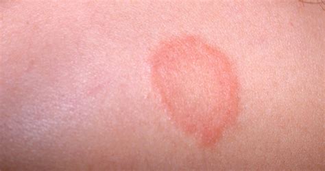 Baby Dry Skin Patch Leading Causes Treatments And