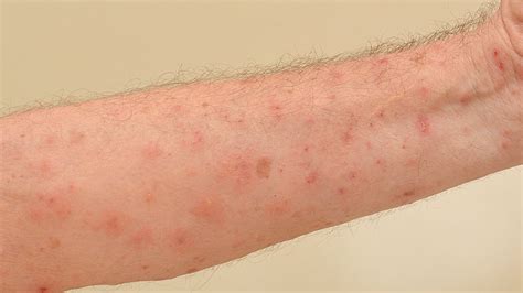 how to identify scabies rash scabies rash scabies skin rashes pictures atelier yuwa ciao jp