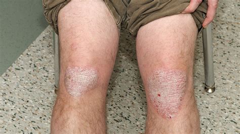 Is That Rash Psoriasis Psoriasis Pictures And More Everyday Health