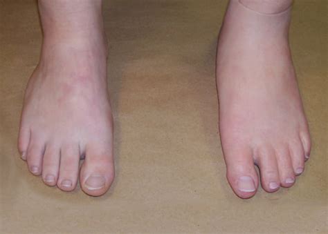 Foot Restorations Alternative Prosthetic Services