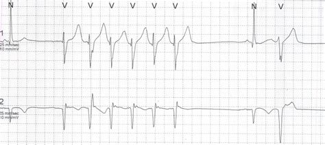 Polymorphic Vpc And Nsvt On Holter All About Cardiovascular System