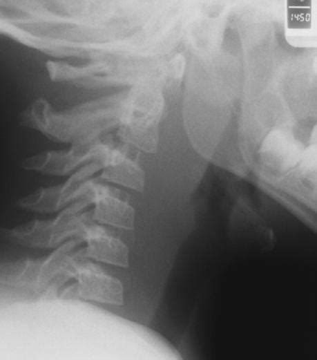Radiology In Ped Emerg Med Vol 5 Case 1