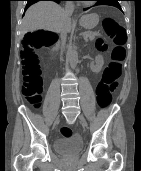 Virtual Colonoscopy Insight Medical Imaging