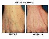 Age Spot Removal Hands Photos