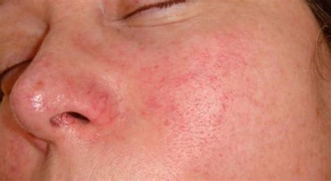 Redness Around Nose Causes Symptoms Treatments And Home Remedies