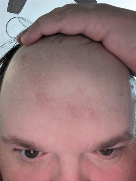 Dryflakyscaly Forehead Rdermatologyquestions