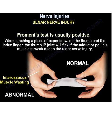 Overview Of Nerve Injuries —