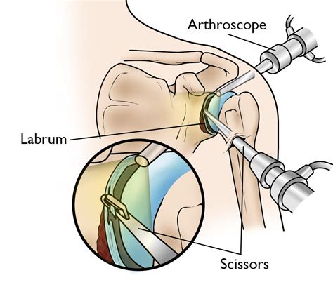 Shoulder Arthroscopy Showing A Slap Tear Of Proximal Labrum Stock Photo