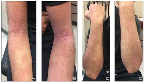 Atopic Dermatitis Triggered By Omalizumab And Treated With Dupilumab