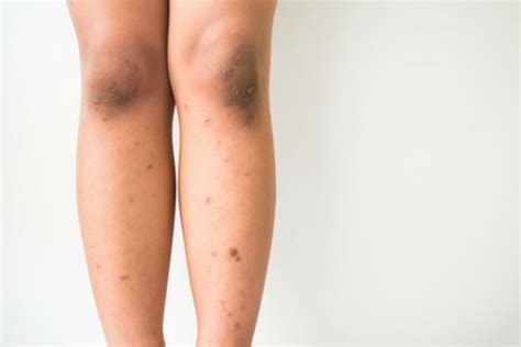 Brown Spots On Legs Causes And Cures