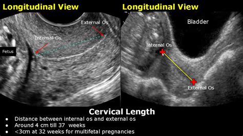 how to measure cervical length on ultrasound transabdominal and transvaginal views cervix