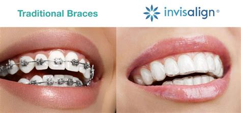 Which Invisible Braces Are Best Us Dental