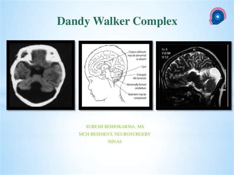 Dandy Walker Syndrome