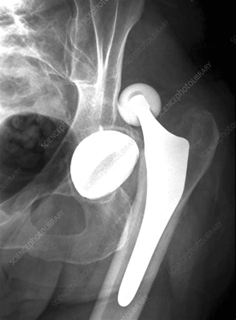 Dislocated Hip Replacement X Ray Stock Image C0489278 Science