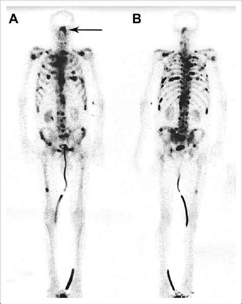 Bone Scintigraphy Showing Multiple Metastases Including To The Head