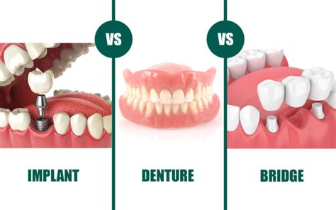 Dental Restorations In SAPTeeth Royal Dental Clinics Blog