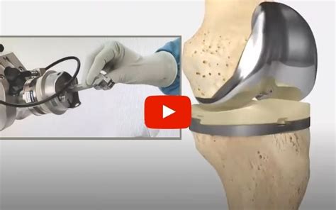 Robotic Knee Replacement Everything You Need To Know Northeast