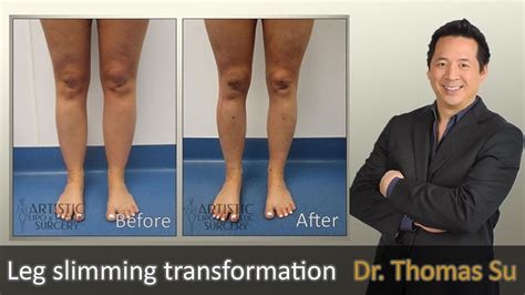 Lipedema Surgery Liposuction Lipo 360 Cankles And Knees Ankles