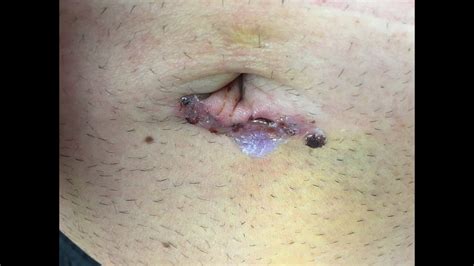 My Umbilical Hernia Repair Surgery And Recovery Doovi