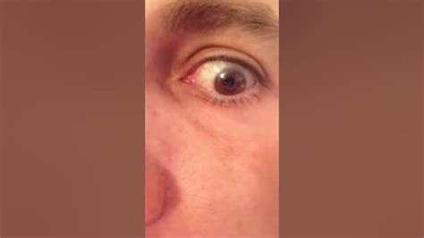 Eye Lens Flicker After Cataract Surgery 2 Dysphotopsia Youtube