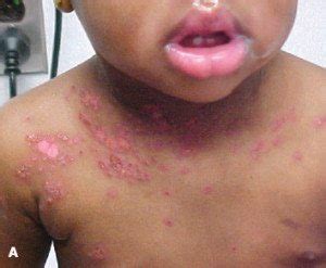 The lymph nodes in their neck and at the base of the skull may also be swollen. Eczema: It's an Itchy Situation for Your Twins - Twiniversity