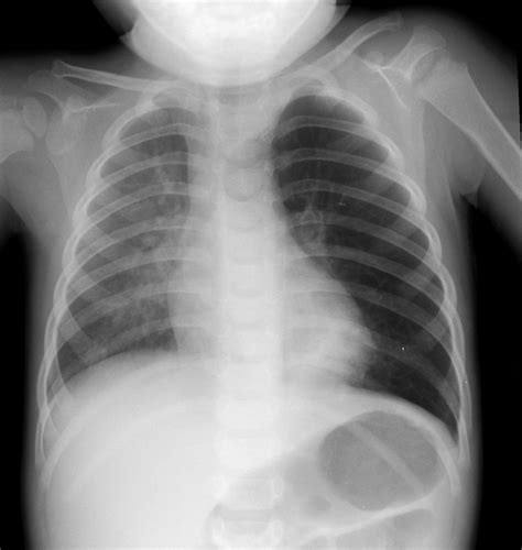 Chest X Ray Child Pediatric Pulmonologists