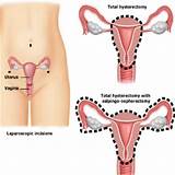 Ablation Uterus Recovery Images