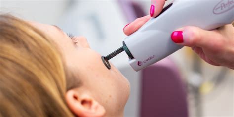 Laser Therapy For Unwanted Blood Vessels Peraza Dermatology Group