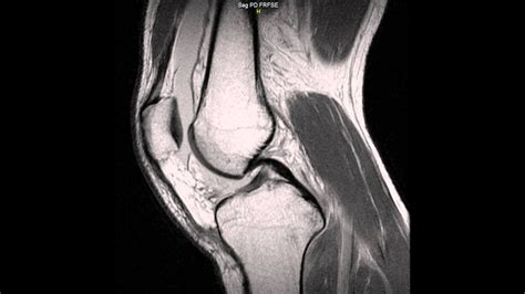 The first choice for professional athletes worldwide. MRI on my Left Knee - Possible Torn Meniscus (doctors ...